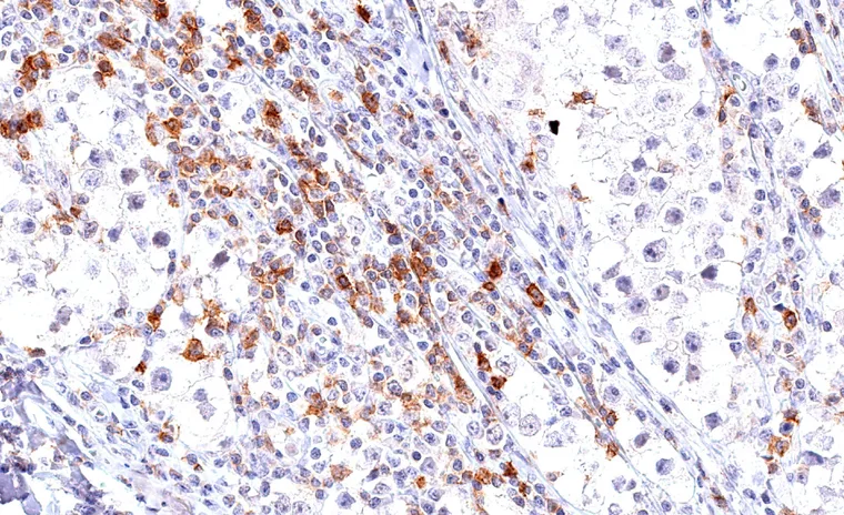 Strong TIGIT expression in a large number of tumor infiltrating lymphocytes in a seminoma with dense lymphocytic infiltrate.