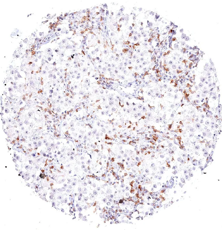 Strong TIGIT expression in tumor infiltrating lymphocytes in a seminoma with sparse lymphocytic infiltrate.