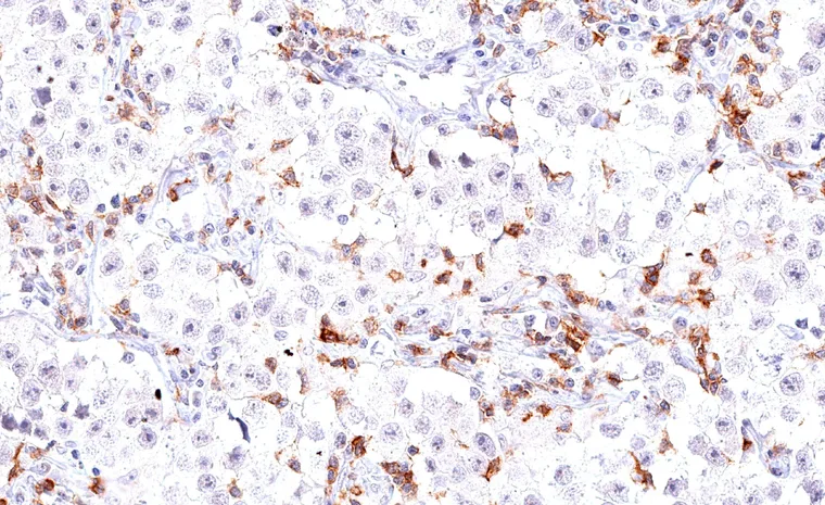 Strong TIGIT expression in tumor infiltrating lymphocytes in a seminoma with sparse lymphocytic infiltrate.