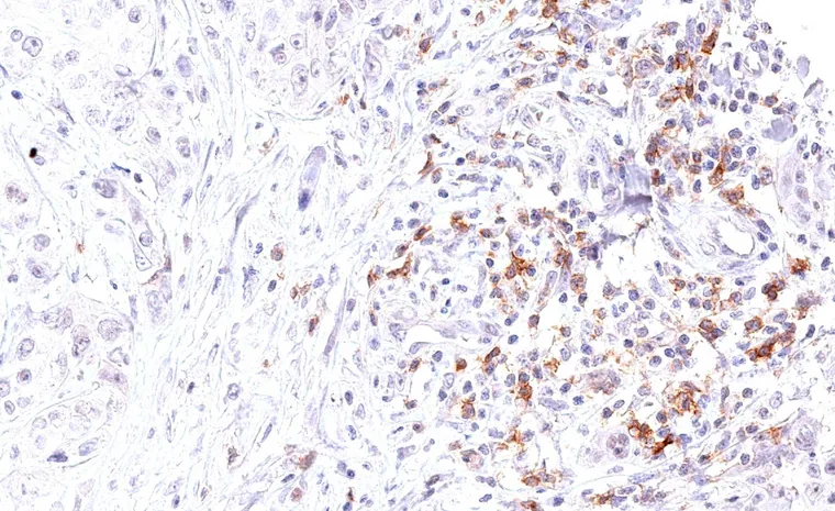 High fraction of TIGIT positive cells in peritumoral lymphocytes in a case of penis carcinoma.