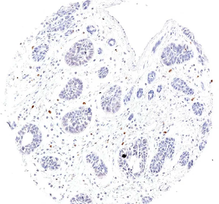 Low grade neuroendocrine carcinoma with scattered infiltrate containing TIGIT positive lymphocytes.