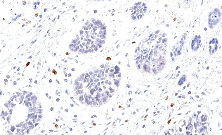Low grade neuroendocrine carcinoma with scattered infiltrate containing TIGIT positive lymphocytes.