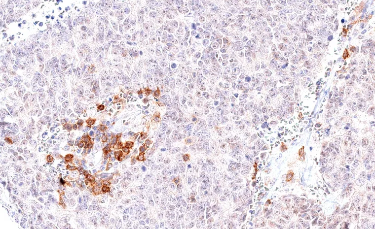 High grade neuroendocrine carcinoma with focal accumulation of TIGIT positive lymphocytes.