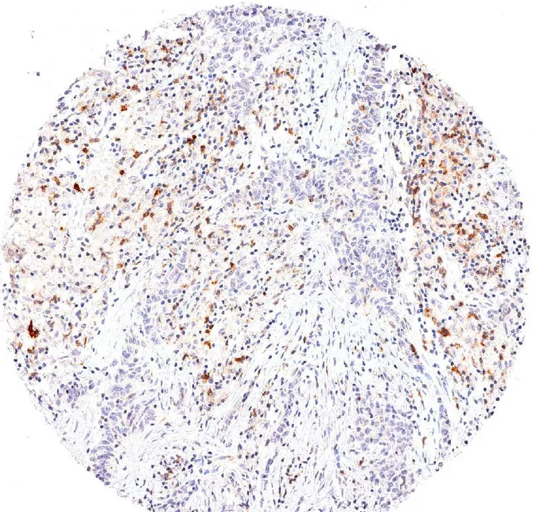 High frequency of TIGIT positive lymphocytes in a lymphoepithelial carcinoma.