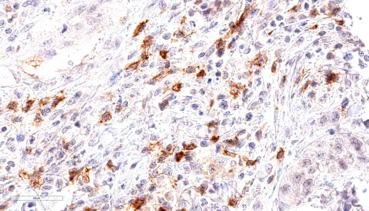 Dense peritumoral infiltrate of TIGIT positive lymphocytes in a laryngeal squamous cell carcinoma.
