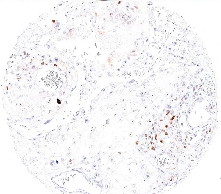 TIGIT IHC, overview and detail.