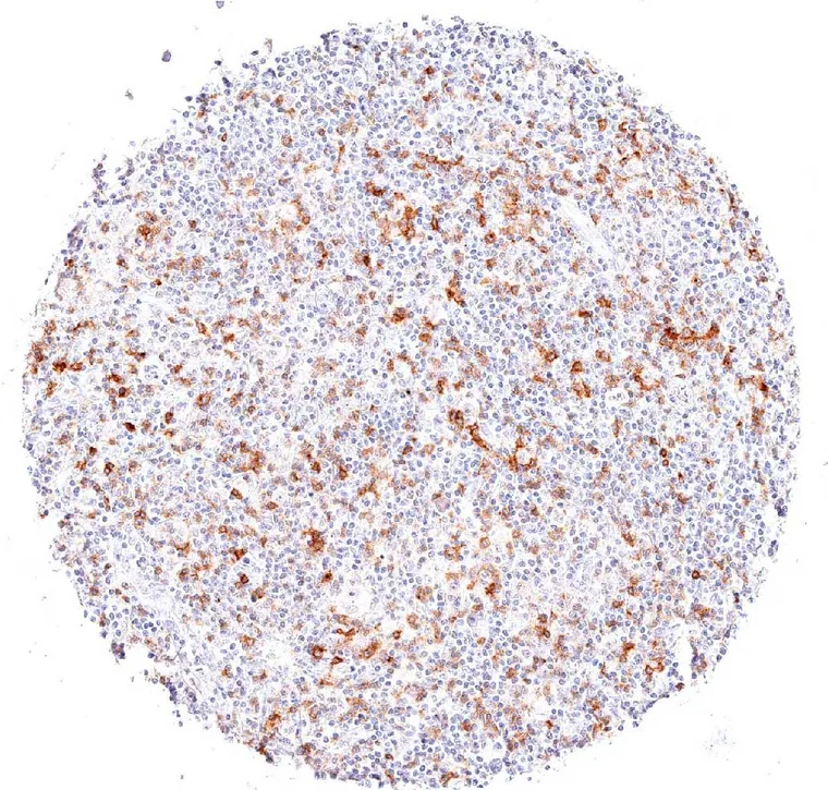 High frequency of TIGIT positive lymphocytes in a Hodgkin lymphoma.