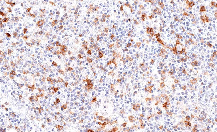 High frequency of TIGIT positive lymphocytes in a Hodgkin lymphoma.