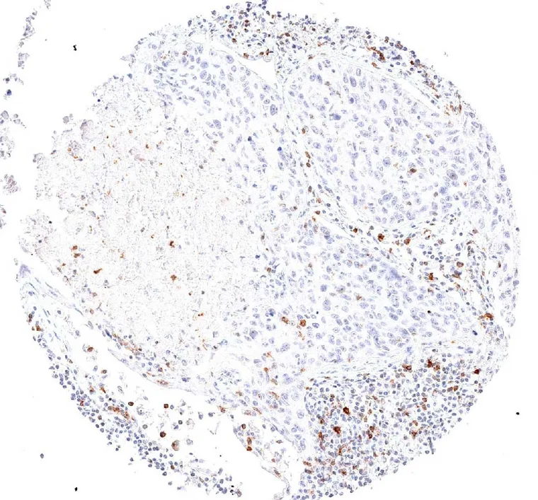 TIGIT positive lymphocytes are present in the peritumoral and intratumoral lymphocytic infiltrate of a squamous cell carcinoma of the lung.