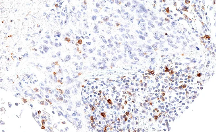 TIGIT positive lymphocytes are present in the peritumoral and intratumoral lymphocytic infiltrate of a squamous cell carcinoma of the lung.