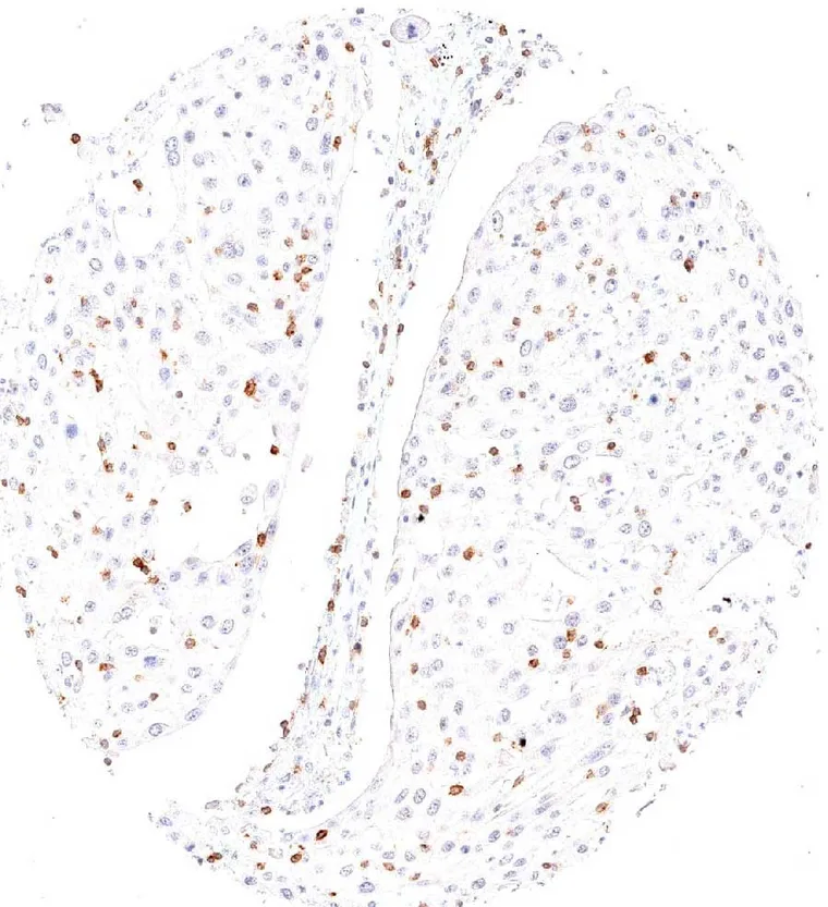 High frequency of TIGIT positive intratumoral lymphocytes in a squamous cell carcinoma of the lung.