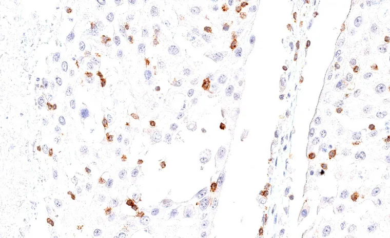 High frequency of TIGIT positive intratumoral lymphocytes in a squamous cell carcinoma of the lung.