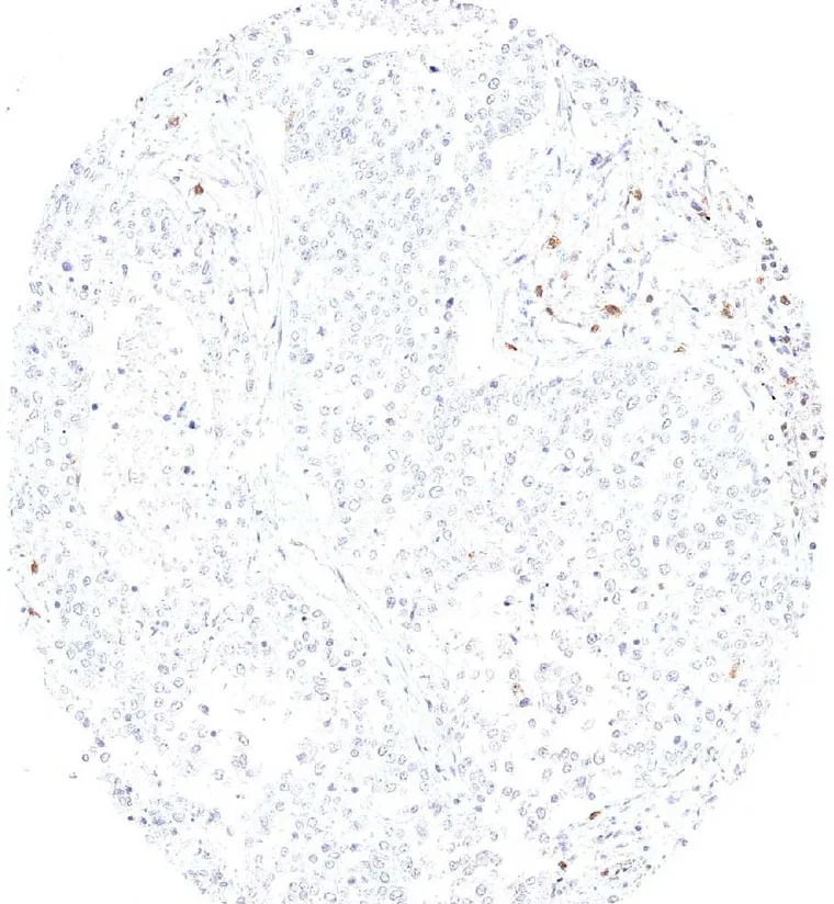 TIGIT positive lymphocytes are located peritumoral but not intratumoral in a squamous cell carcinoma.