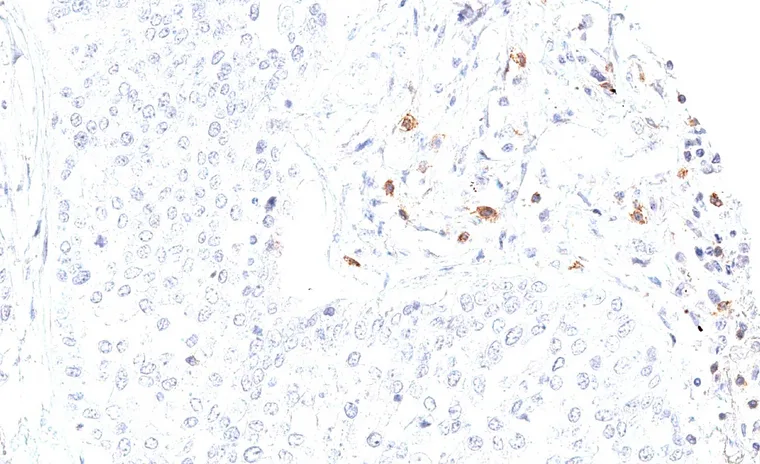 TIGIT positive lymphocytes are located peritumoral but not intratumoral in a squamous cell carcinoma.