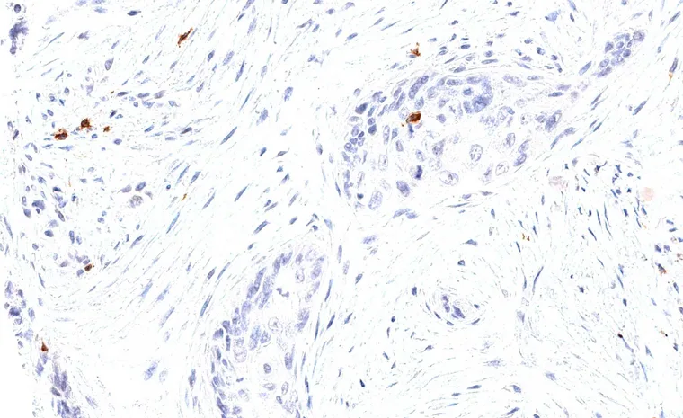 Sparse TIGIT positive lymphocytes in a squamous cell carcinoma of the lung with strong desmoplastic reaction.