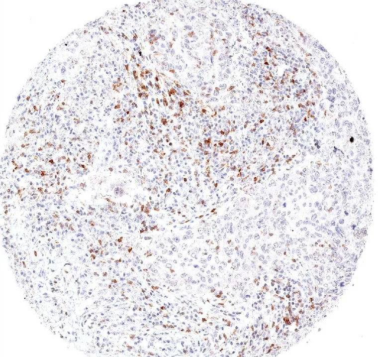High density of TIGIT positive lymphocytes in a squamous cell carcinoma of the lung.