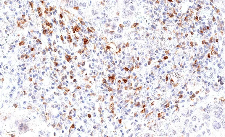 High density of TIGIT positive lymphocytes in a squamous cell carcinoma of the lung.
