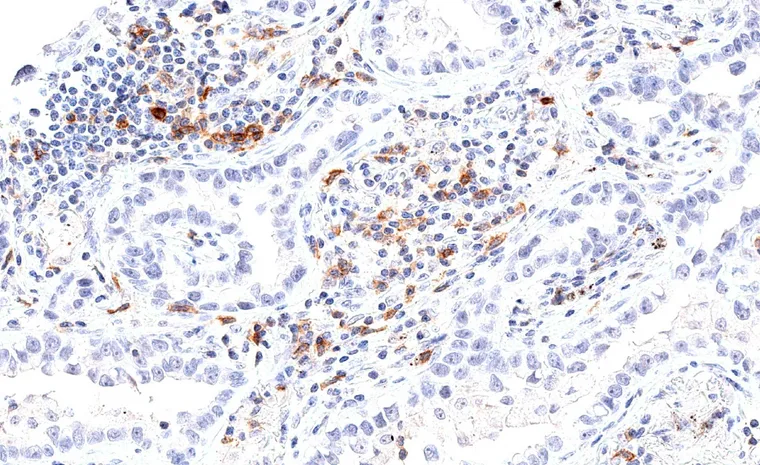 High frequency of TIGIT positive lymphocytes in an adenocarcinoma of the lung.
