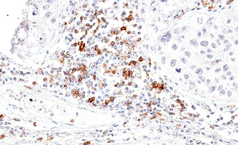 High frequency of peritumoral TIGIT positive lymphocytes in a large cell adenocarcinoma of the lung.