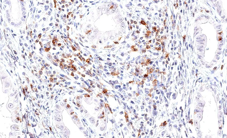 Abundant TIGIT positive lymphocytes in an adenocarcinoma of the ampulla of Vater.