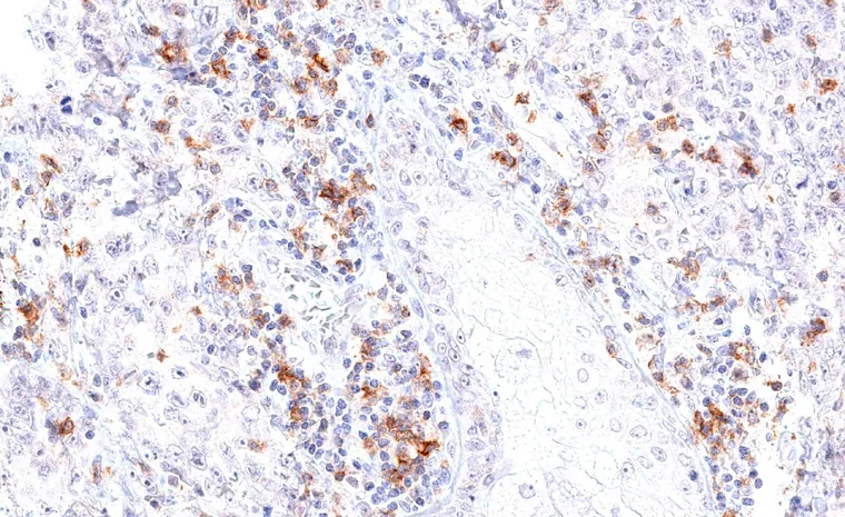 High number of TIGIT positive lymphocytes in an angiosarcoma.