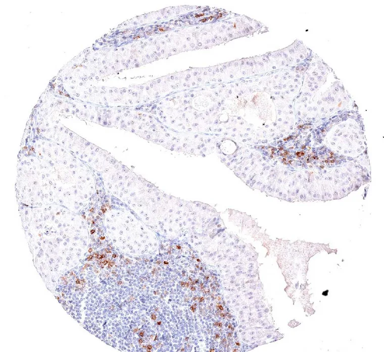 TIGIT positive lymphocytes are abundant in a Warthin tumor.