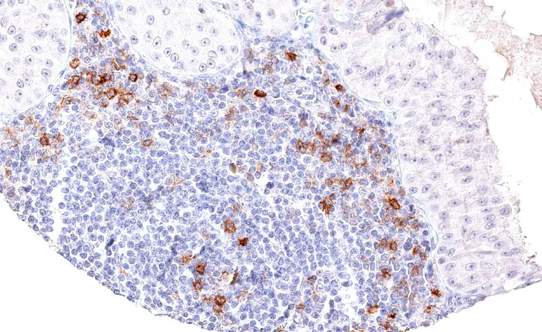 TIGIT positive lymphocytes are abundant in a Warthin tumor.