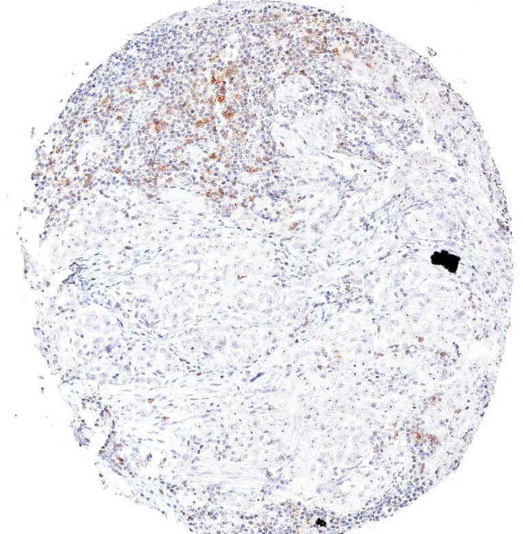 Dense infiltration of an ovarian carcinoma by TIGIT positive lymphocytes.