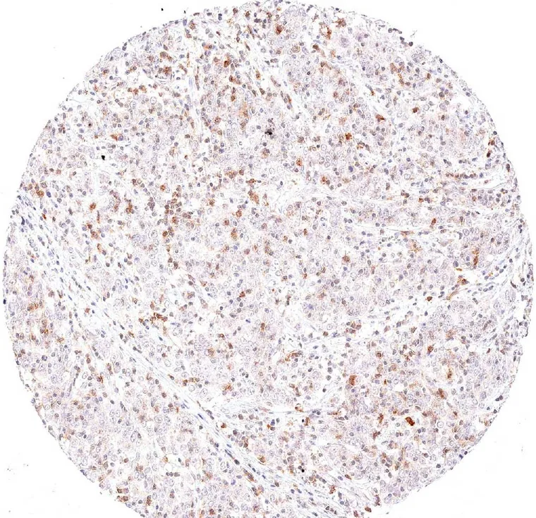 A cervix uteri squamous cell carcinoma with numerous intratumoral TIGIT positive lymphocytes.