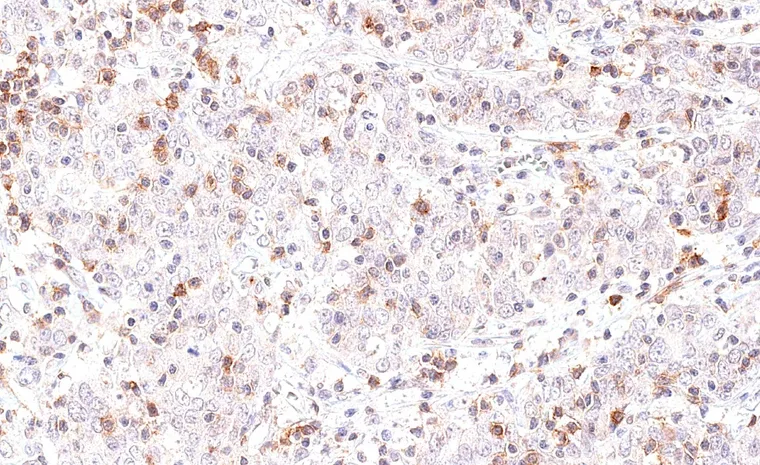 A cervix uteri squamous cell carcinoma with numerous intratumoral TIGIT positive lymphocytes.