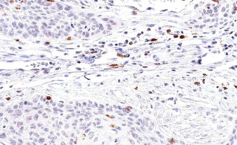 Squamous cell carcinoma of the uterine cervix with peritumoral and intratumoral infiltrate of TIGIT positive lymphocytes.