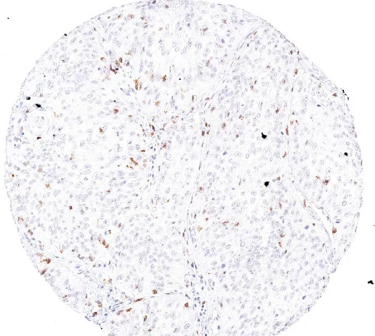 Squamous cell carcinoma of the uterine cervix with abundant intratumoral infiltrate of TIGIT positive lymphocytes.