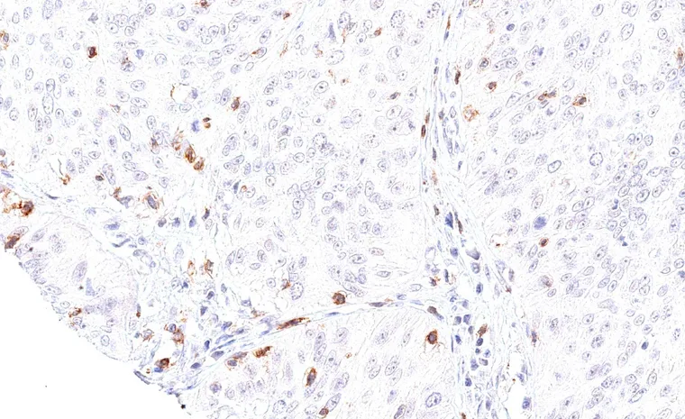 Squamous cell carcinoma of the uterine cervix with abundant intratumoral infiltrate of TIGIT positive lymphocytes.