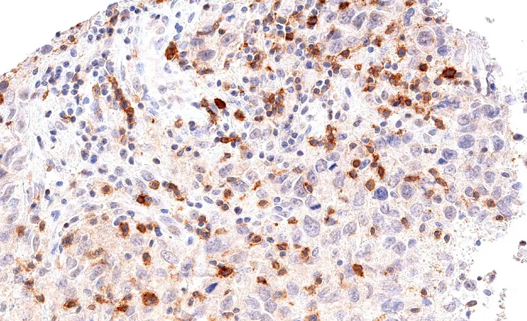 High density of TIGIT positive lymphocytes in a medullary breast cancer.