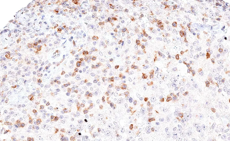 A case of medullary breast cancer with abundant TIGIT positive lymphocytes.