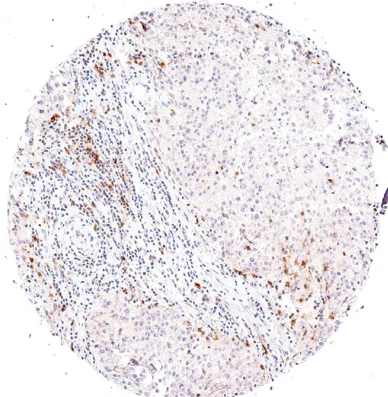 High density of peritumoral and intratumoral TIGIT positive lymphocytes in a medullary breast cancer.