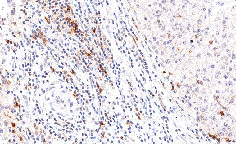 High density of peritumoral and intratumoral TIGIT positive lymphocytes in a medullary breast cancer.
