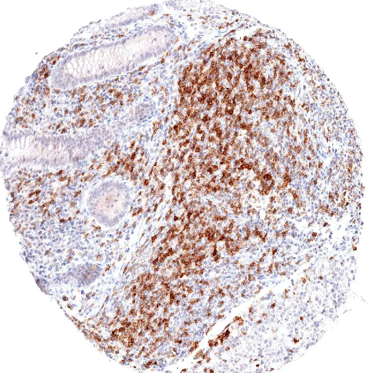Appendix mucosa with dense accumulation of TIGIT positive lymphocytes.
