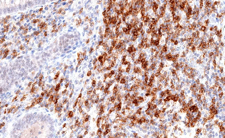 Appendix mucosa with dense accumulation of TIGIT positive lymphocytes.