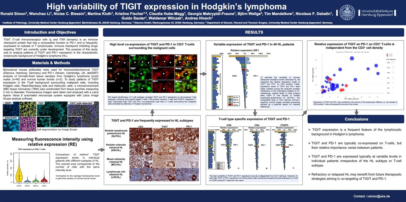 Congress poster: High variability of TIGIT expression in Hodgkin’s lymphoma (AACR Annual Meeting 2018)