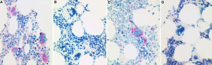 CAL2 IHC across four MPN cases, two positive and two negative.