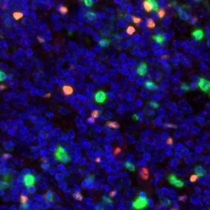 CD112R × FOXP3 fluorescence multiplex immunohistochemistry, 40× — official ONCOdianova image