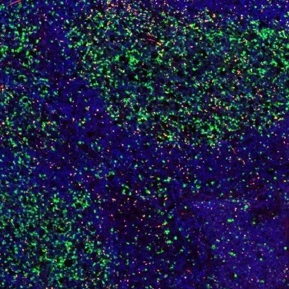 CD112R × FOXP3 fluorescence multiplex immunohistochemistry, 4× — official ONCOdianova image