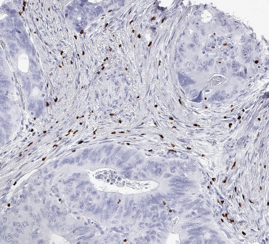 Immunohistochemistry of human FOXP3 with anti-FOXP3 clone FX3 (DIA-FX3) in FFPE tissue – FOXP3-positive cells (designated regulatory T cells in the source legend) in the stroma of a colorectal adenocarcinoma; figure 03 of the previous ONCOdianova FOXP3 gallery and figure A of the datasheet.