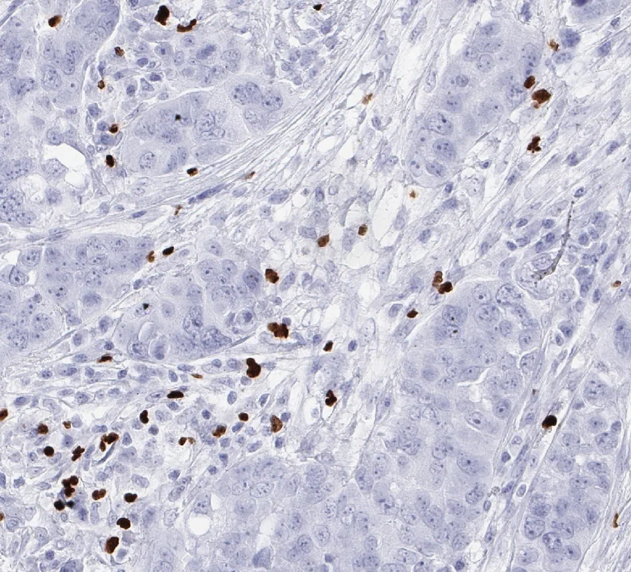 Immunohistochemistry of human FOXP3 with anti-FOXP3 clone FX3 (DIA-FX3) in FFPE tissue – FOXP3-positive tumour-infiltrating lymphocytes in a high-grade serous ovarian carcinoma; figure 04 of the previous ONCOdianova FOXP3 gallery and figure B of the datasheet.
