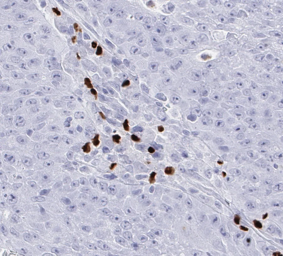 Immunohistochemistry of human FOXP3 with anti-FOXP3 clone FX3 (DIA-FX3) in FFPE tissue – focal accumulation of FOXP3-positive tumour-infiltrating lymphocytes in a solid cancer; the source file name designates the tissue as pancreatic carcinoma, 40×; figure 05 of the previous ONCOdianova FOXP3 gallery.