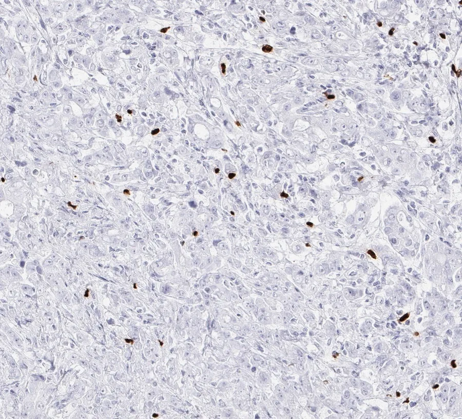 Immunohistochemistry of human FOXP3 with anti-FOXP3 clone FX3 (DIA-FX3) in FFPE tissue – FOXP3-positive tumour-infiltrating lymphocytes; the source file name designates the tissue as stomach carcinoma, 20×; figure 06 of the previous ONCOdianova FOXP3 gallery.