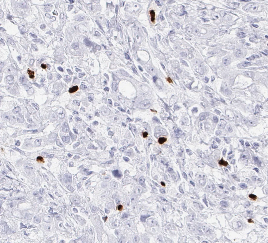 Immunohistochemistry of human FOXP3 with anti-FOXP3 clone FX3 (DIA-FX3) in FFPE tissue – higher magnification of the same cancer as in figure 06; the source file name designates the tissue as stomach carcinoma, 40×; figure 07 of the previous ONCOdianova FOXP3 gallery.