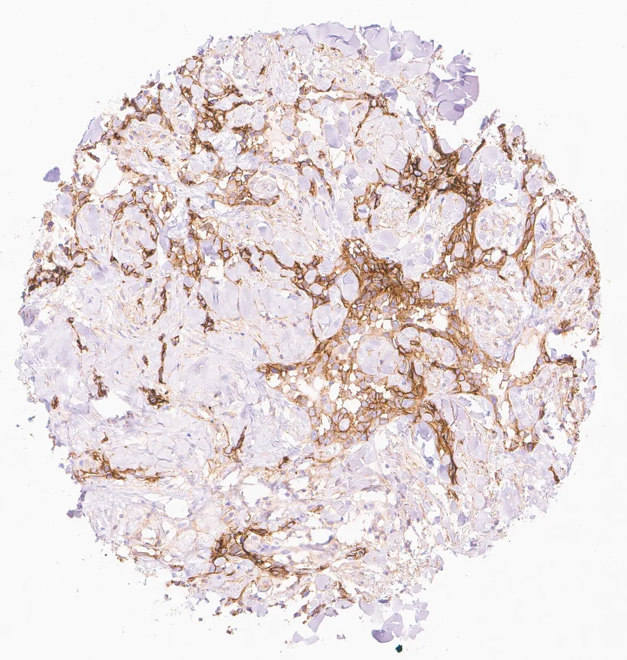 Immunohistochemistry of human CD73 (NT5E) with anti-CD73 clone KK3 (DIA-KK3) in FFPE tissue – strong membranous CD73 staining in an angiosarcoma; figure 08 of the previous ONCOdianova CD73 gallery.