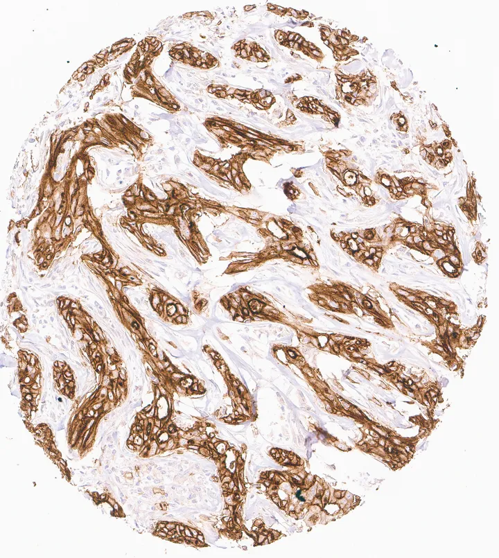 Immunohistochemistry of human CD73 (NT5E) with anti-CD73 clone KK3 (DIA-KK3) in FFPE tissue – strong homogeneous CD73 immunostaining in a cholangiocellular carcinoma of the liver; figure 01 of the previous ONCOdianova CD73 gallery.